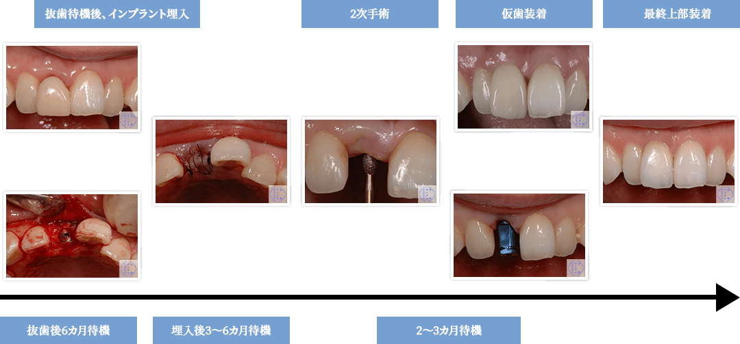 現在、多くの歯科医院で行われているインプラント治療方針
